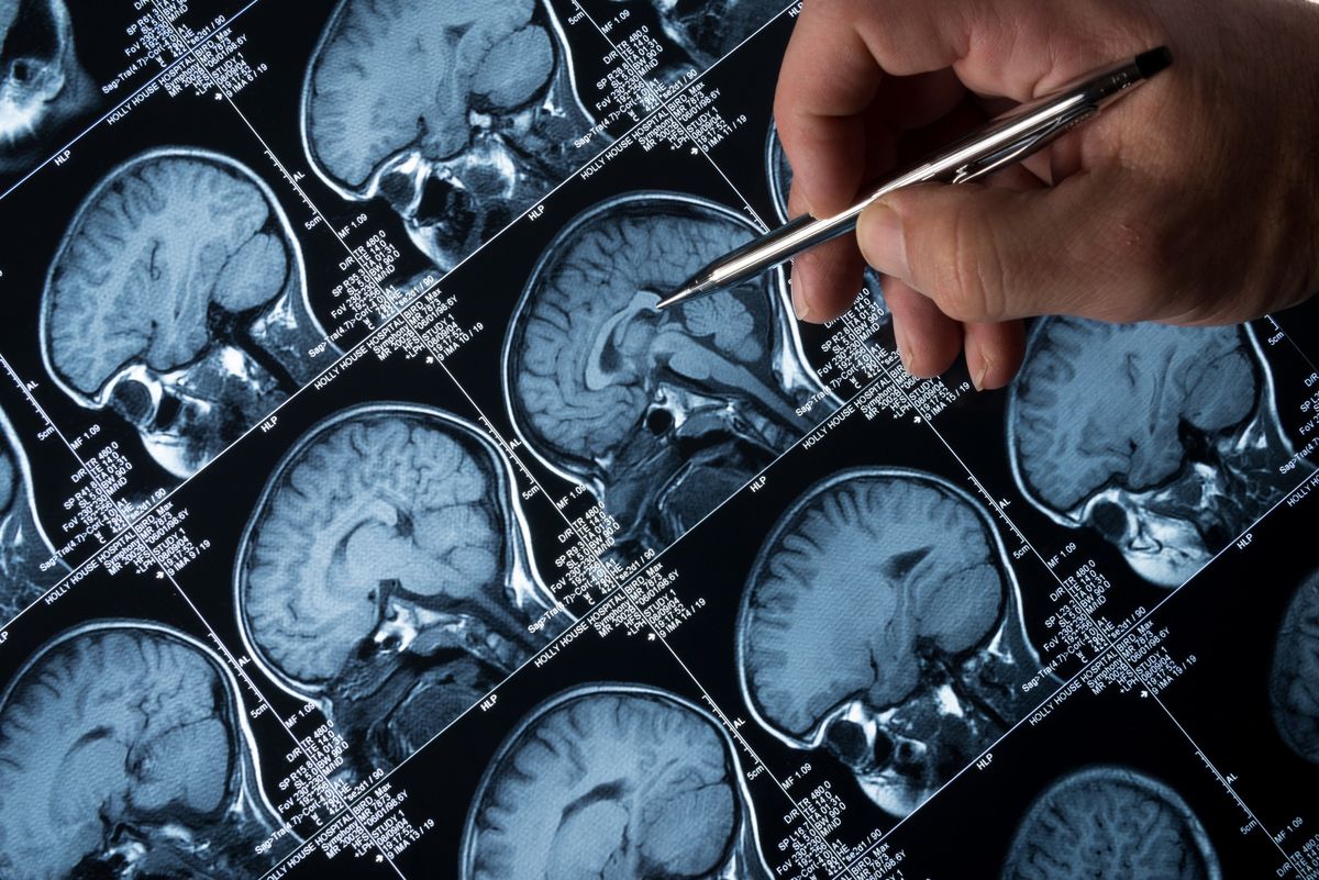 People with two copies of APOE4 genes at higher risk of Alzheimer’s disease