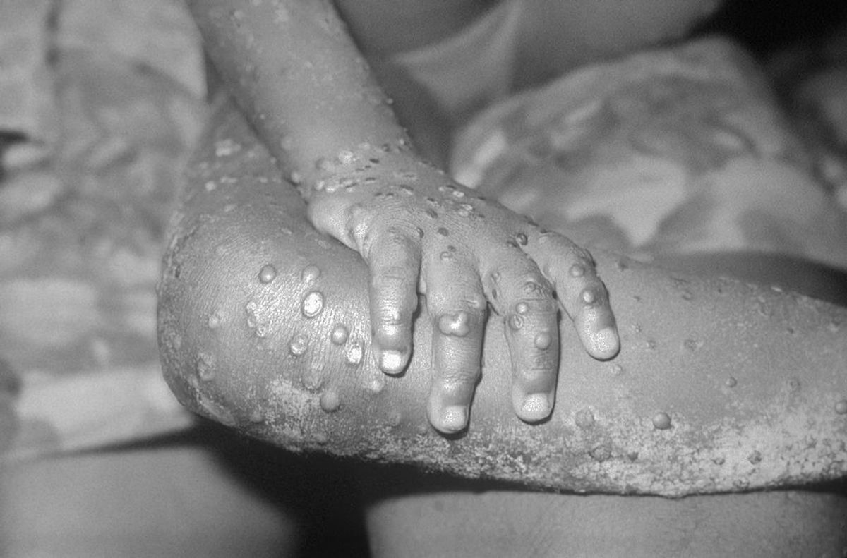 Monkeypox: UK confirms 11 new cases as the disease spreads in Europe