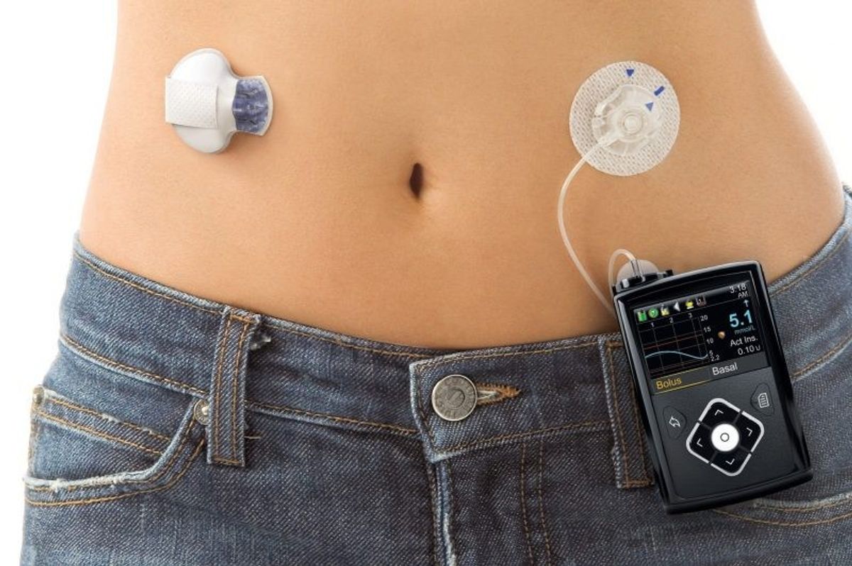NHS: Nearly 900 patients with type 1 diabetes benefit from ‘artificial pancreas’