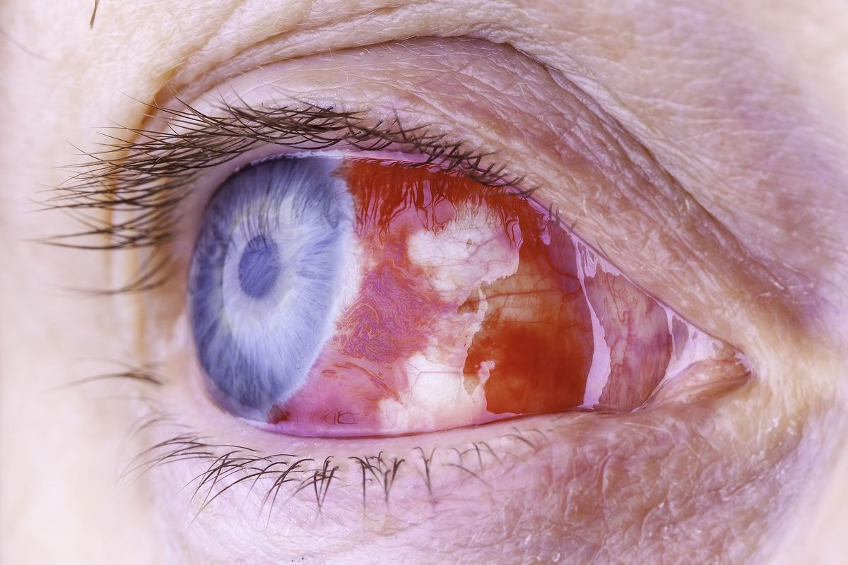This deadly virus causes eye bleeding and kills up to a third of all its victims