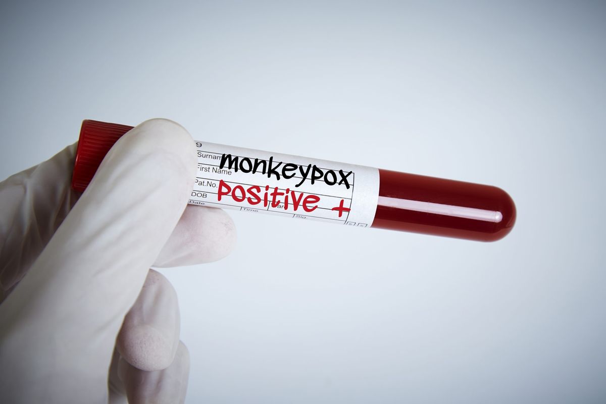 Monkeypox infection may cause serious heart issues – Study