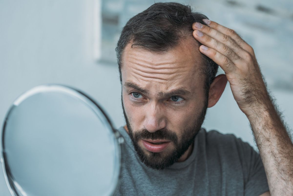 Baldness linked to increase risk of heart disease