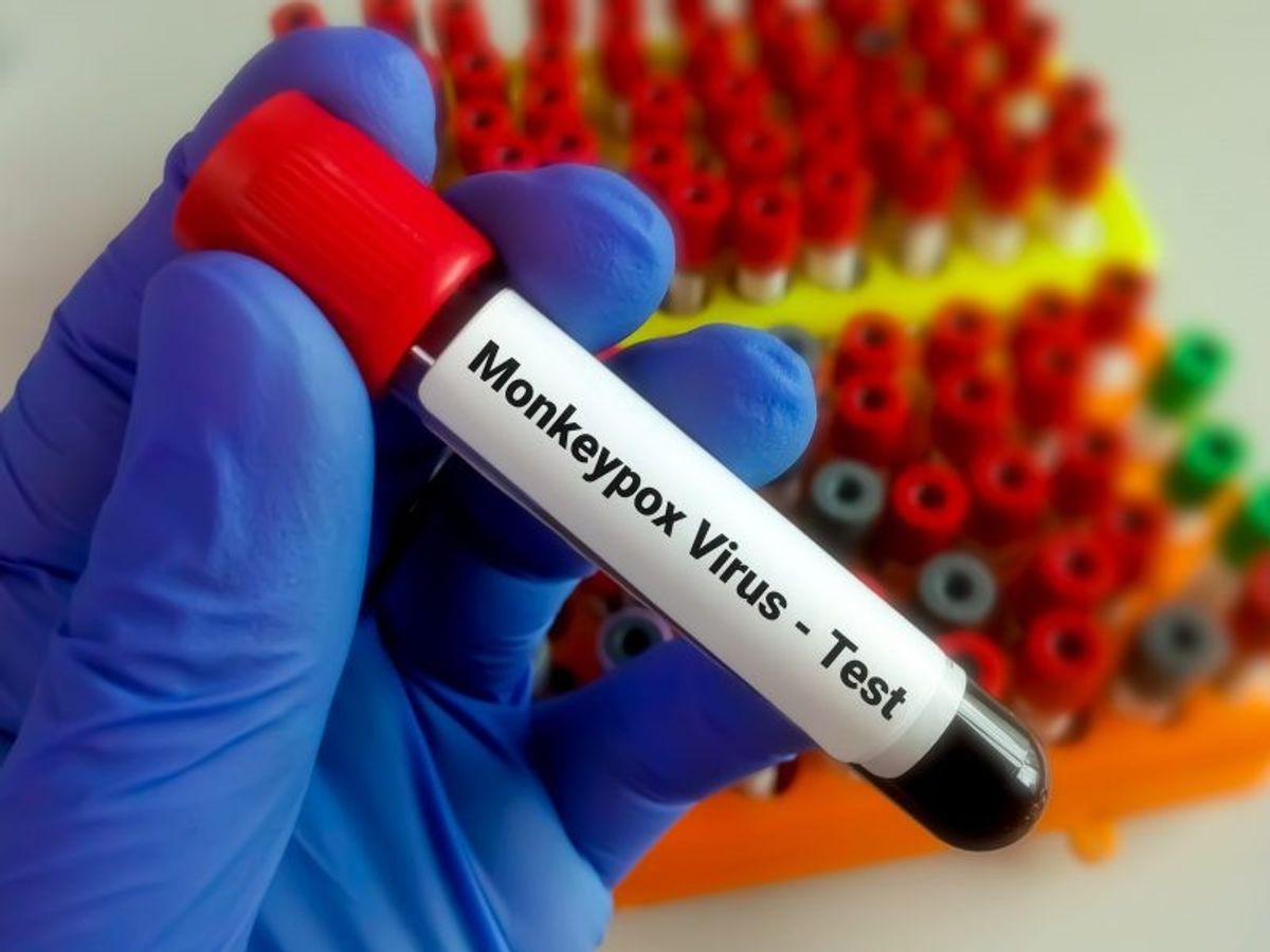 Pak govt dismisses report of monkeypox case in country: Report