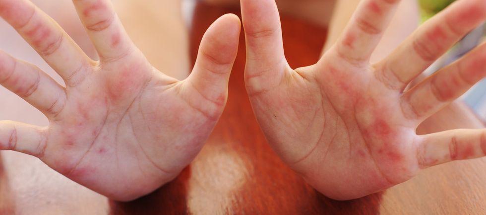 India on high alert as over 100 kids catch Tomato Flu; govt issues advisory to states