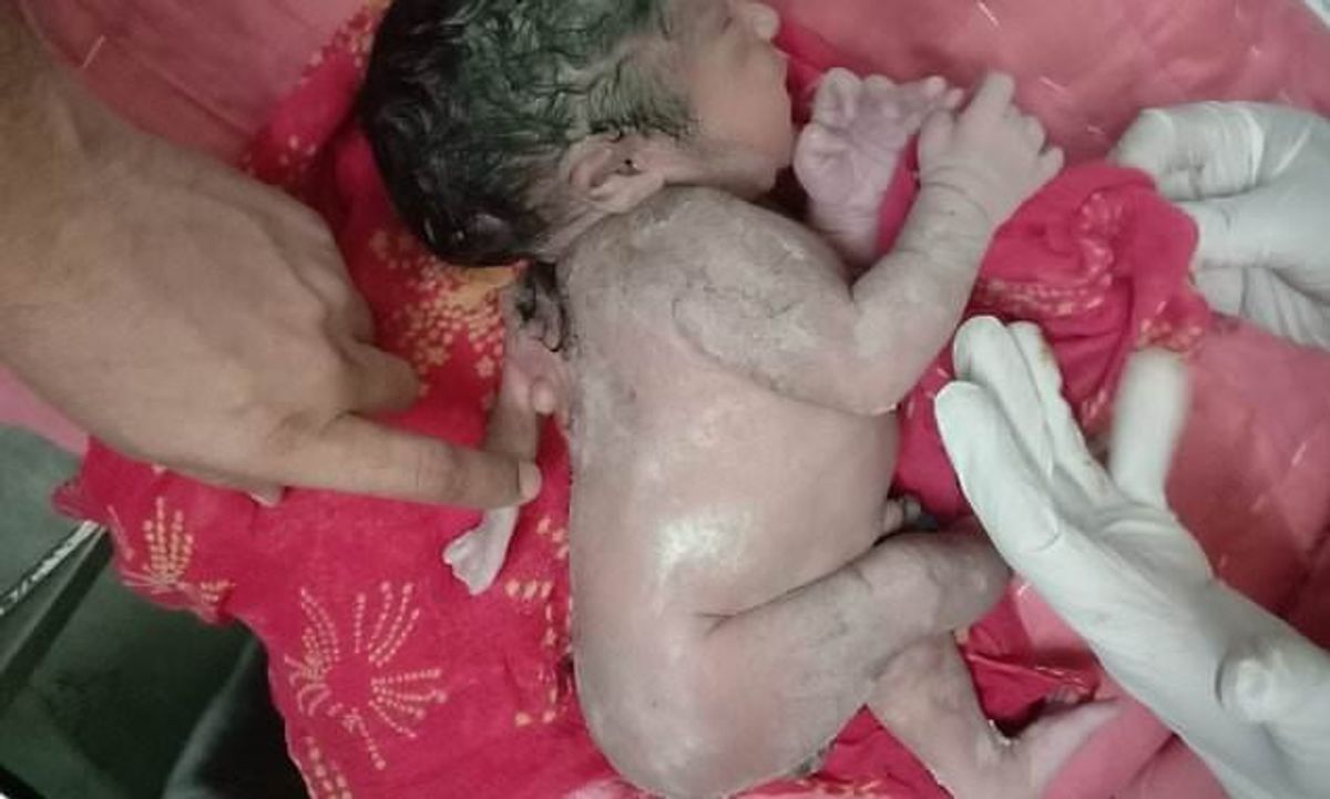 Unusual birth: Baby in India born with third arm protruding from its back