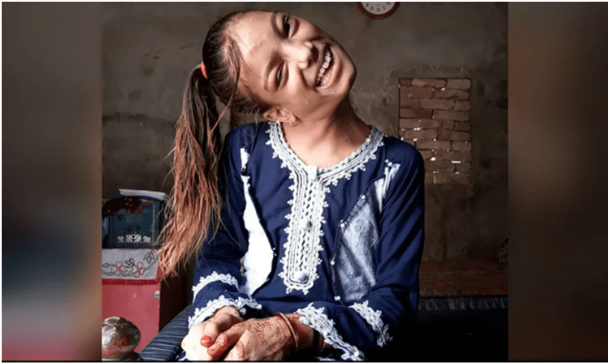 This Pakistani girl with neck bent at 90 degrees was treated successfully for free by Indian doctor