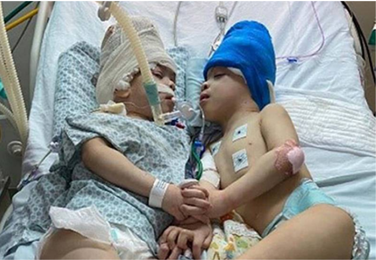 British Asian paediatric neurosurgeon separates Brazilian conjoined twins with fused brains