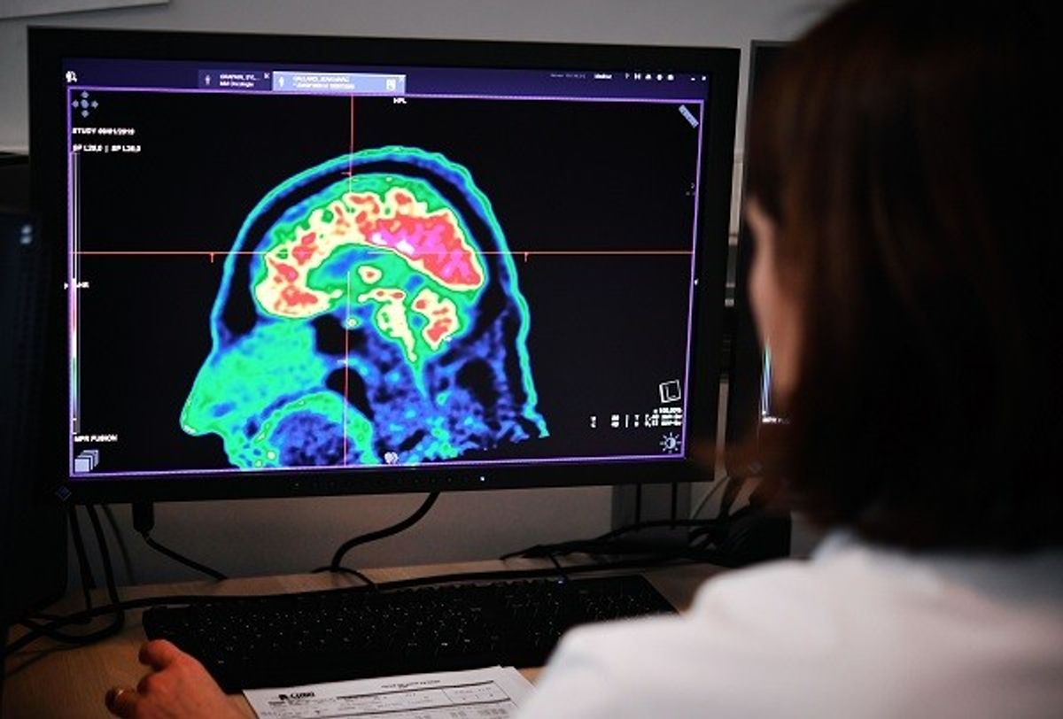 Healthy Living May Support To Offset Genetic Risk Of Dementia: Study