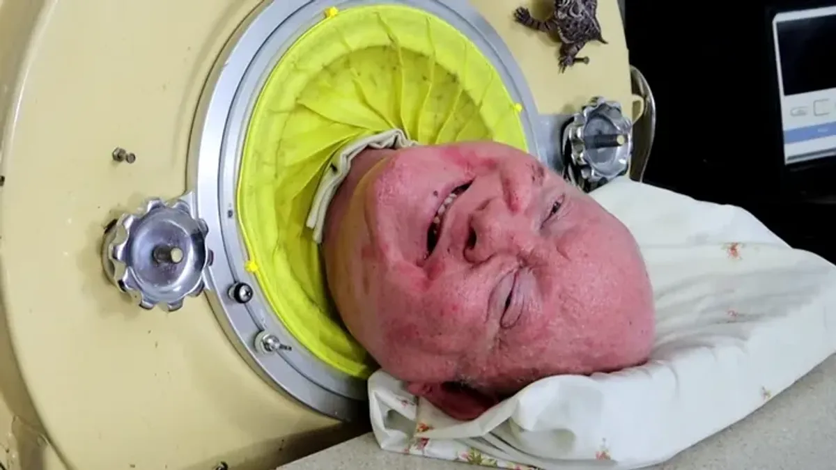 ‘Polio Paul’ who lived in an iron lung, dies at 78