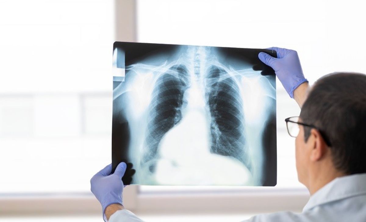 England witnessing surge in tuberculosis cases: Health agency report