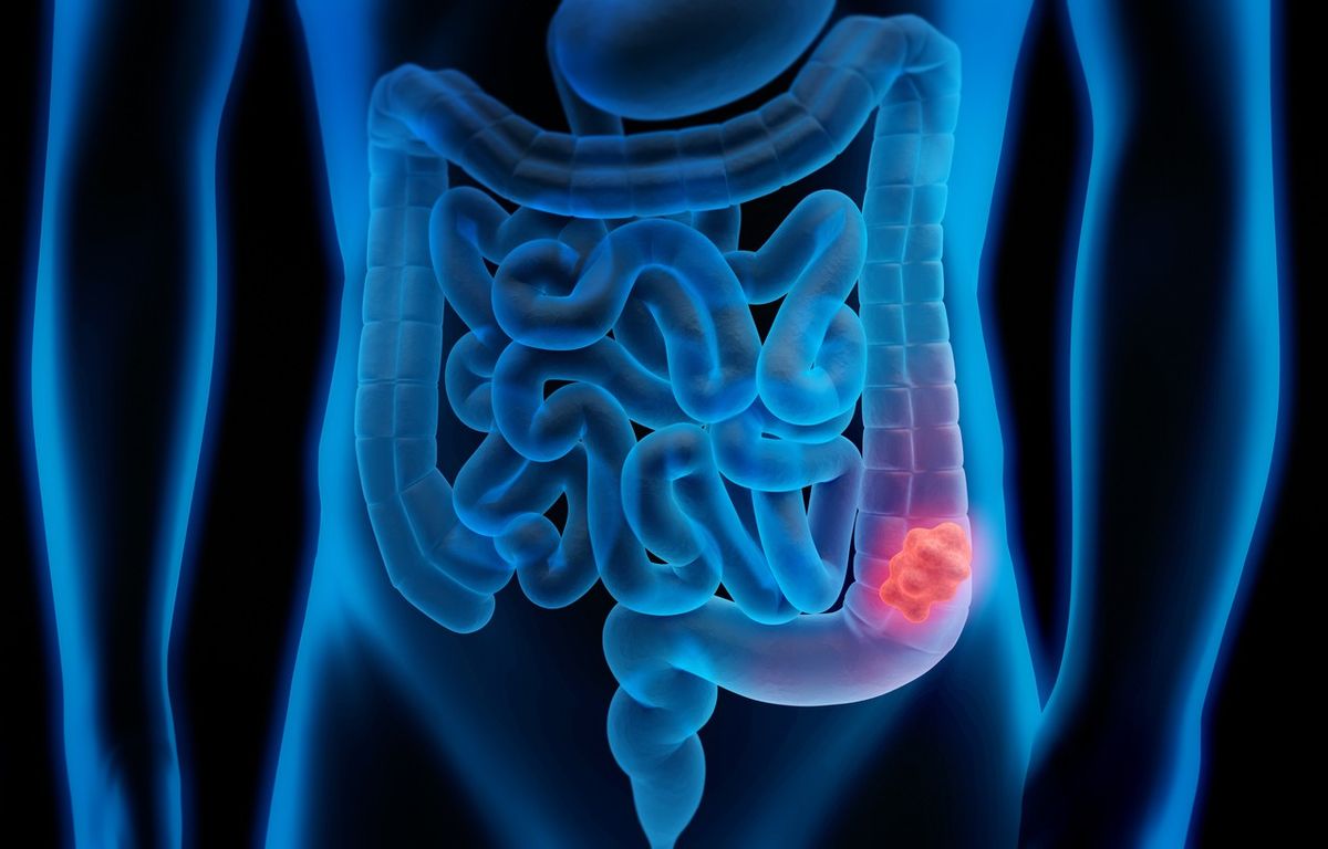 Mouth bacteria linked to colon cancer growth, says study