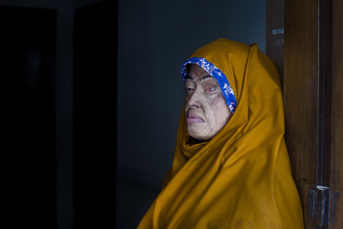 British Asian Trust extends support for acid, burn violence survivors in Bangladesh