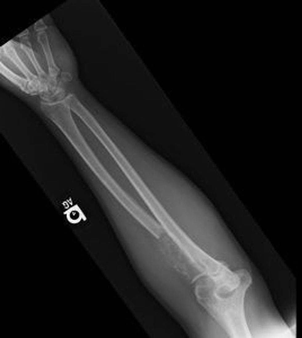 Tumor Myeloma Radius (Cancer)